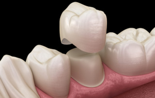 Dental Crowns