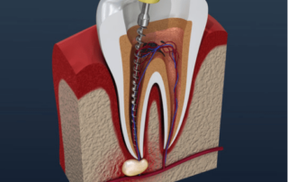 Root Canal Treatment