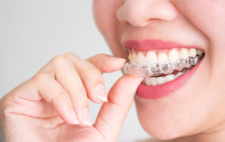 Invisalign Treatment