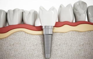 Dental implant