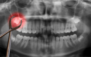 wisdom tooth