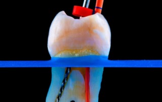 Root canals