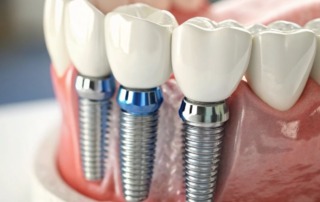 Dental Implants