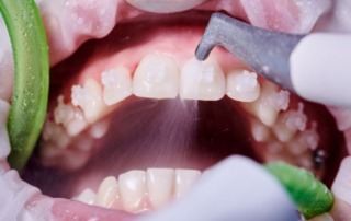 dental cleaning