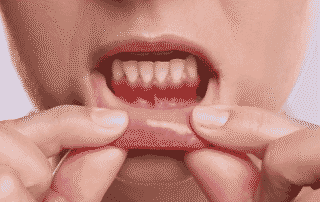 Improving gum health at home with preventive dental care from Renova Smiles