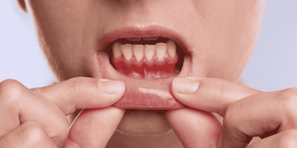 Improving gum health at home with preventive dental care from Renova Smiles